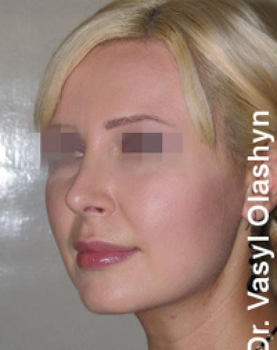 NOSE SHAPE CORRECTION NOSE SHAPE CORRECTION