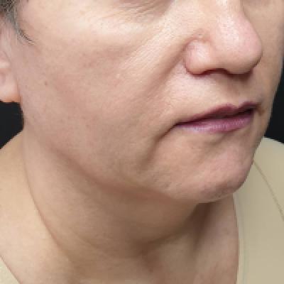 LIP CONTOURING LIP CONTOURING