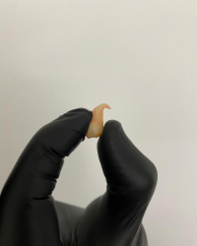 WISDOM TOOTH EXTRACTION WISDOM TOOTH EXTRACTION