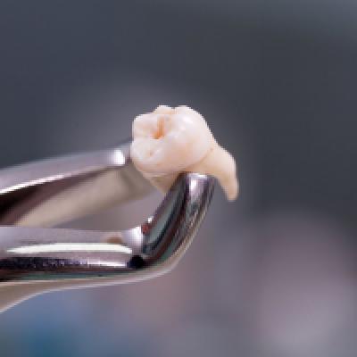COMPLEX TOOTH EXTRACTIONS COMPLEX TOOTH EXTRACTIONS