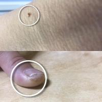 REMOVAL OF SKIN LESIONS