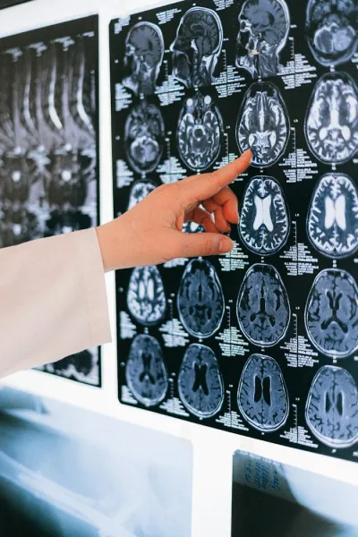 Chronic fatigue and migraine syndrome